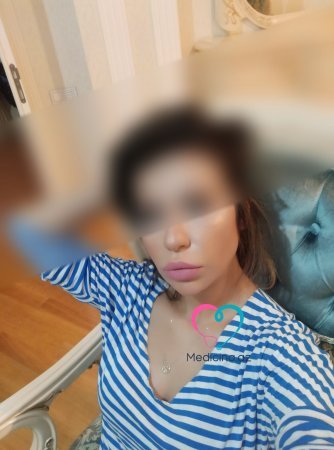 Daha bir estetik əməliyyat faciəsi: Baş həkim həmkarının burnunu tanınmaz hala saldı - FOTO