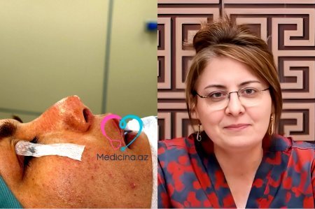 Daha bir estetik əməliyyat faciəsi: Baş həkim həmkarının burnunu tanınmaz hala saldı - FOTO
