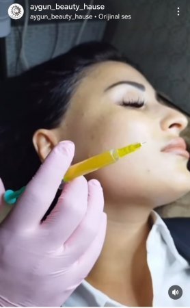 Dodaq dolğusu, plazma terapiya-Saxta ixtisaslaşmış həkimlər….-Araşdırma