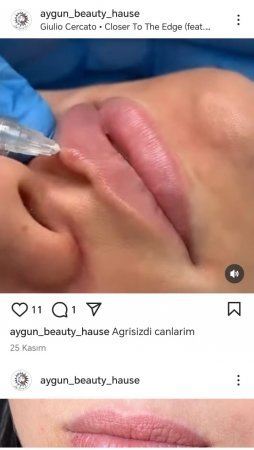 Dodaq dolğusu, plazma terapiya-Saxta ixtisaslaşmış həkimlər….-Araşdırma